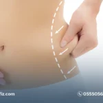 تكلفة شفط الدهون في السعودية 2026